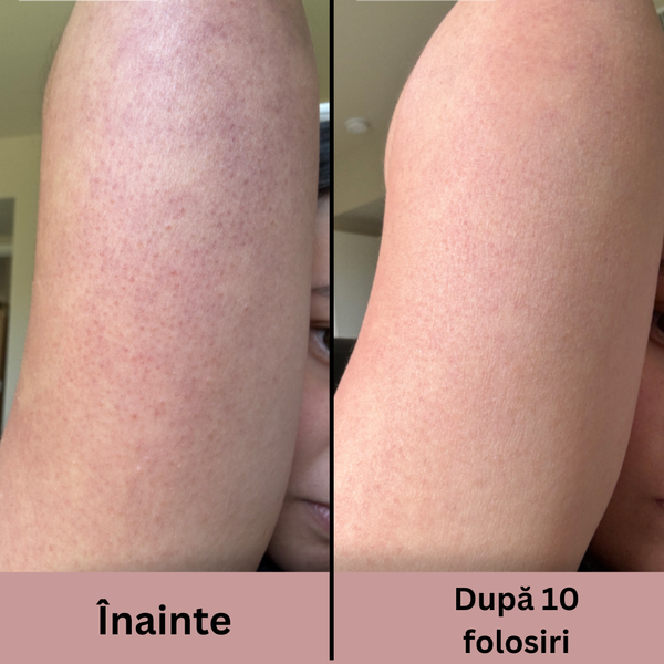 Exfoliant Avansat pentru Piele Aspră și Keratoză Pilară