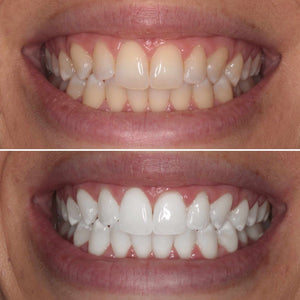 Teeth-Whitening-1.jpg